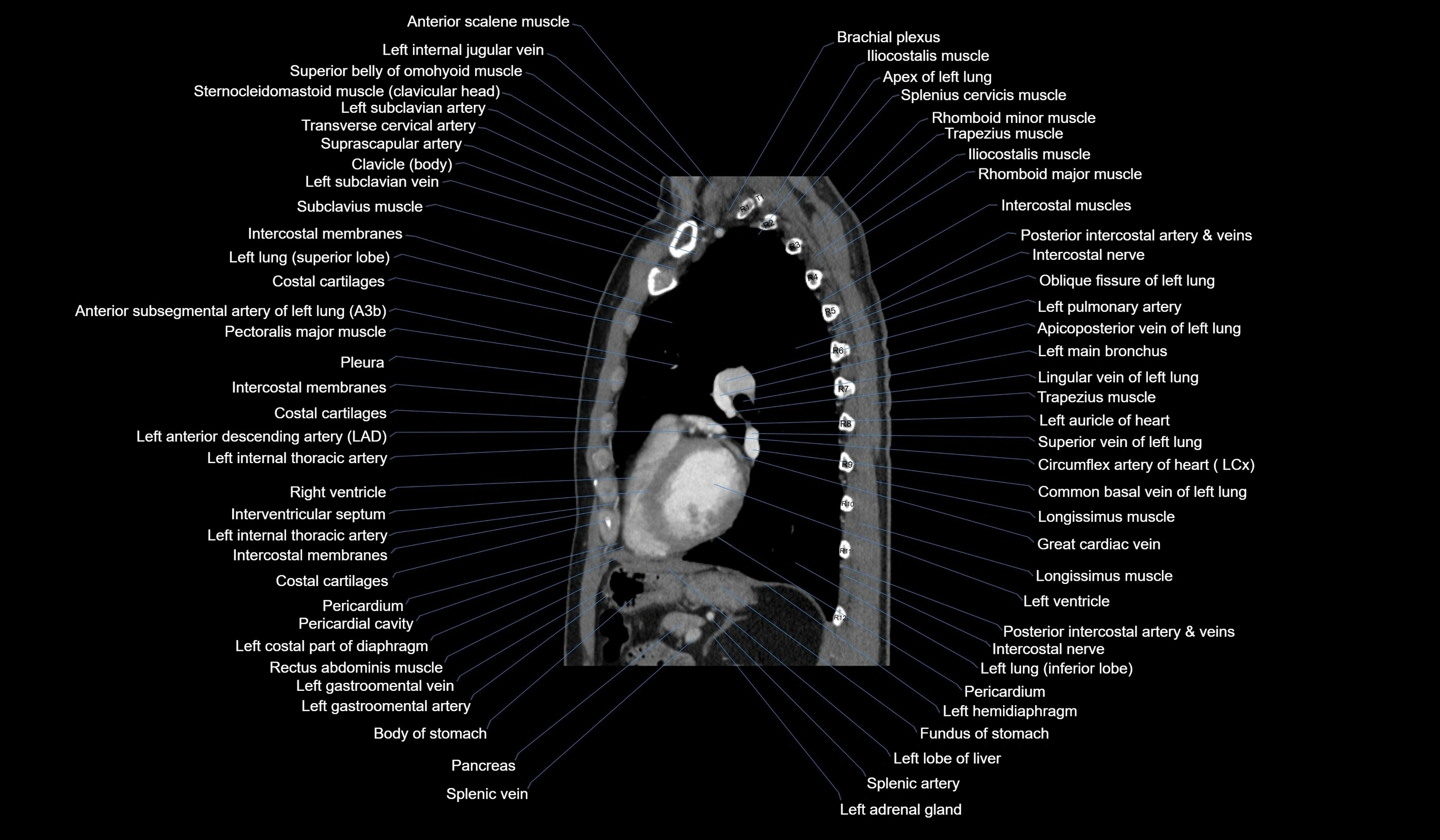 CT chest (thorax) soft tissue window labelled sagittal cross sectional anatomy radiology image-00089.webp